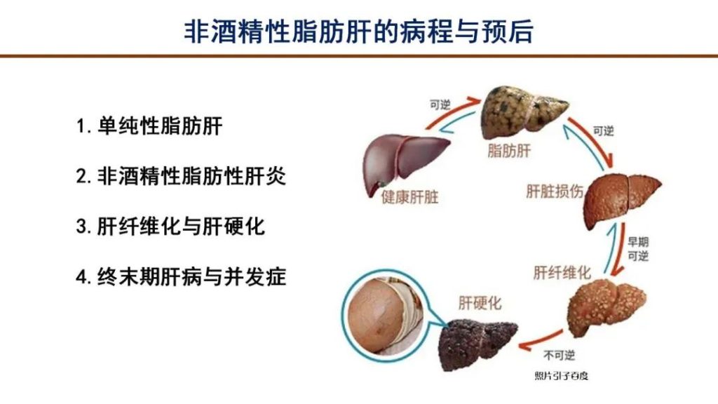 fatty liver